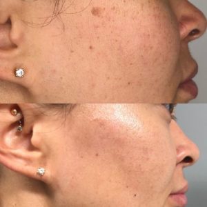 Botox Before & After Treatment | Glowtox in NYC, NY