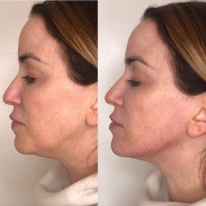 Botox Before & After Treatment | Glowtox in New York, NY