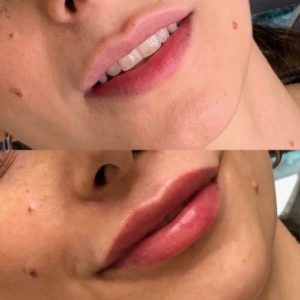 Botox Before & After Treatment | Glowtox in NYC, NY