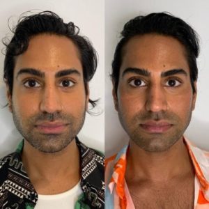 Botox Before & After Treatment | Glowtox in NYC, NY