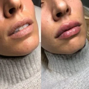 Botox Before & After Treatment | Glowtox in NYC, NY