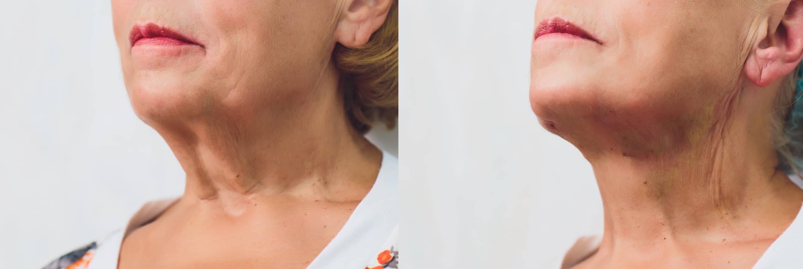 Kybella Before & After Treatments | Glowtox in New York, NY